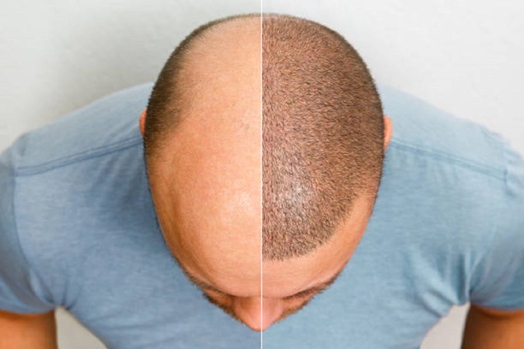 FUE hair transplant
